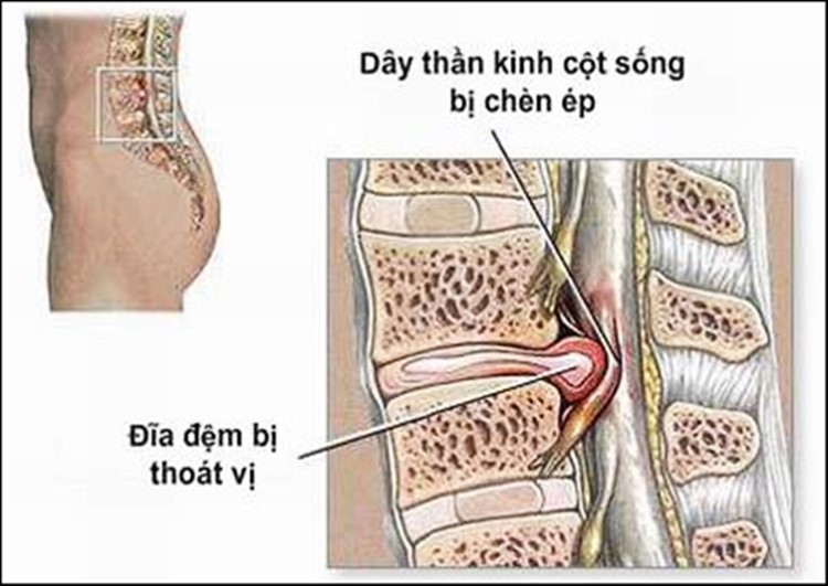 Thoát vị đĩa đệm
